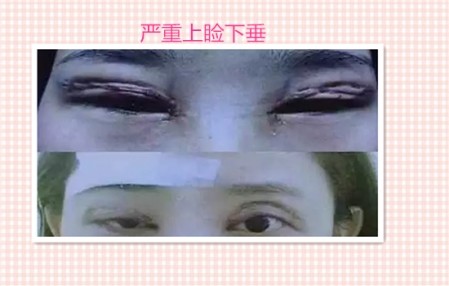 这些都是割双眼皮失败案例图片,看完你还敢割双眼皮吗?