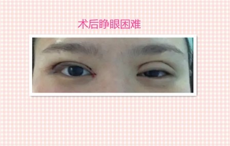 这些都是割双眼皮失败案例图片,看完你还敢割双眼皮吗?