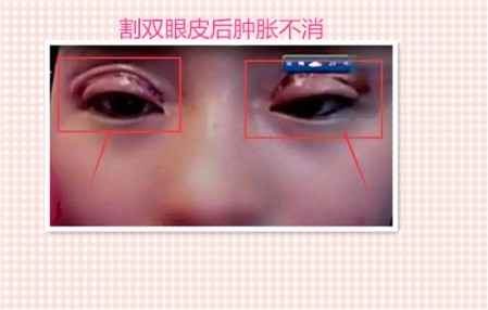 这些都是割双眼皮失败案例图片,看完你还敢割双眼皮吗?