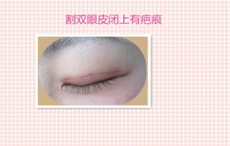 这些都是割双眼皮失败案例图片,看完你还敢割双眼皮吗?