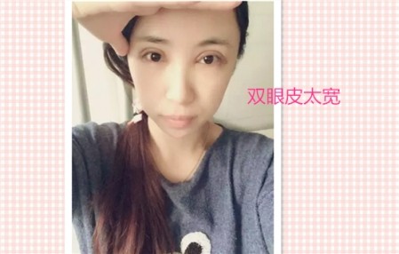 这些都是割双眼皮失败案例图片,看完你还敢割双眼皮吗?