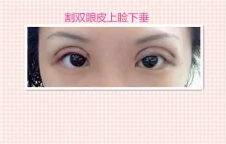 这些都是割双眼皮失败案例图片,看完你还敢割双眼皮吗?