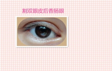 这些都是割双眼皮失败案例图片,看完你还敢割双眼皮吗?