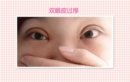 这些都是割双眼皮失败案例图片,看完你还敢割双眼皮吗?