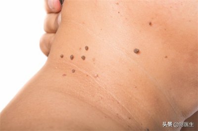 ​脖子长出小肉粒，也会影响健康？注意可能是这几个麻烦找上门