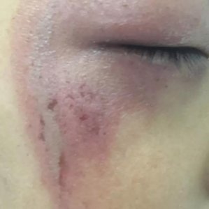 ​这种虫子千万别惹，差点让孩子毁容的隐翅虫皮炎到底有多“凶”？